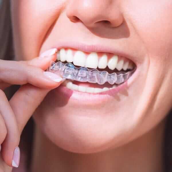 Şeffaf Plaklar (Invisalign)