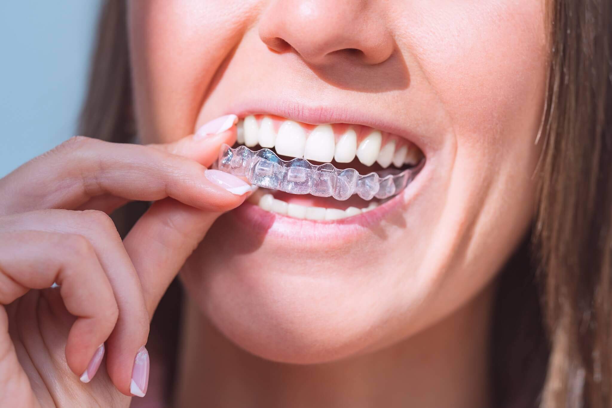 Şeffaf Plaklar (Invisalign)